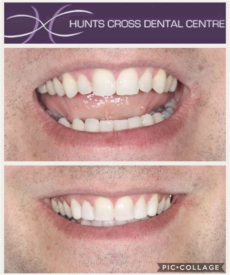 quick straight teeth with composite bonding hunts cross dental centre dentist in liverpool