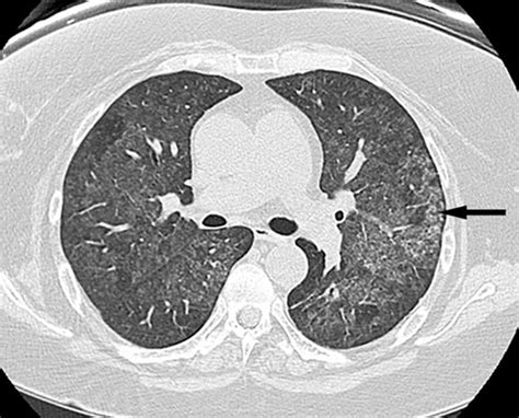 Ground Glass Opacity In Lungs