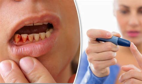 Bleeding Gums Could Be Early Sign Of Diabetes New Study Found Express Co Uk