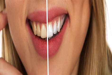 I Migliori Rimedi Per Sbiancare I Denti In Modo Naturale