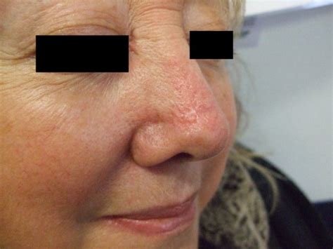 Bcc Right Tip Of Nose Dr Vindy Ghura Dermatologist Manchester
