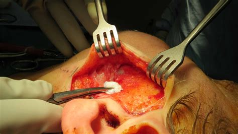 Combined Open And Endoscopic Removal Of Parotid Stone Sialendoscopy