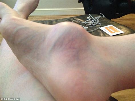 Woman Has Her Leg Amputated After Finding Out Lump She Left For A
