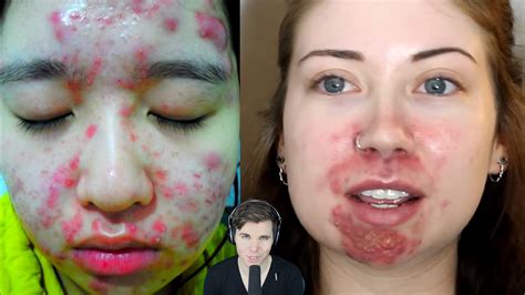 Video Girls With Severe Acne Before And After Cystsscars