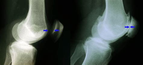 Patellofemoral Joint Replacement Dr Brook Adams Md