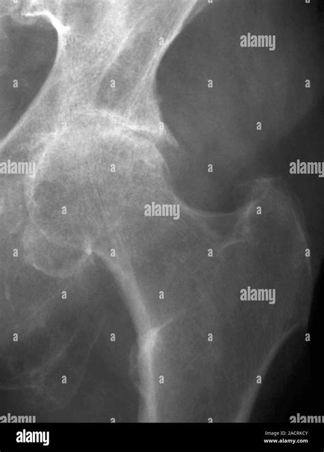Osteoarthritis Of The Hip X Ray The Left Hip Of A 74 Year Old Patient