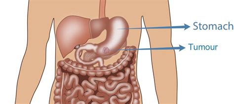 Stomach Cancer Surgery Perth Gastrectomy Abdominal Surgery