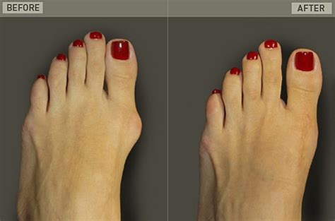 Cosmetic Foot Surgery Before And After Corrective Foot Surgery New York
