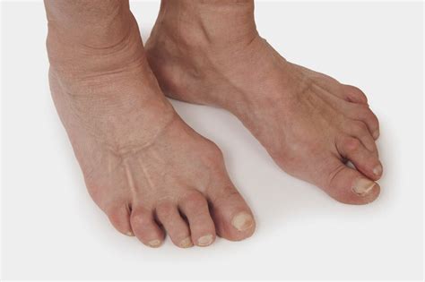 Rheumatoid Arthritis Foot Ankle Specialists In Kelso Tweed Podiatry