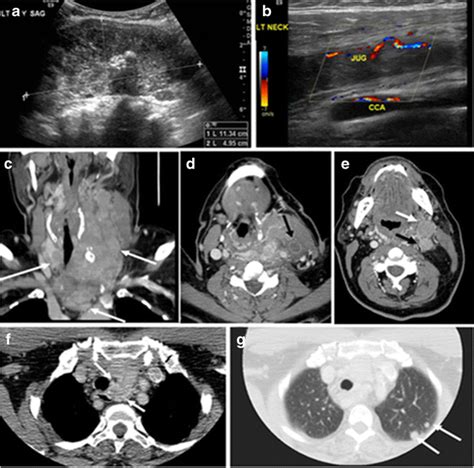 Thyroid Computed Tomography Imaging Pictorial Review Of Variable