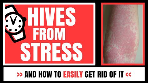 Hives From Stress And How To Easily Get Rid Of It Youtube