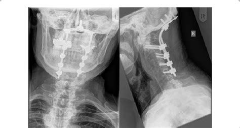 Post Operative Ap And Lateral View Of The Cervical Spine