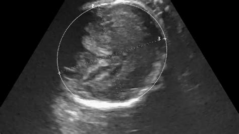 Dandy Walker Syndrome Fetal Ultrasound