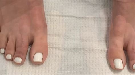 Before And After Pictures Minimally Invasive Toe Shortening Surgery For Long Toes 👠👠👠 Youtube