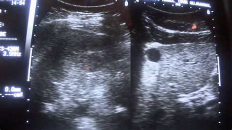 Ultrasound Cyst Vs Solid Mass Youtube