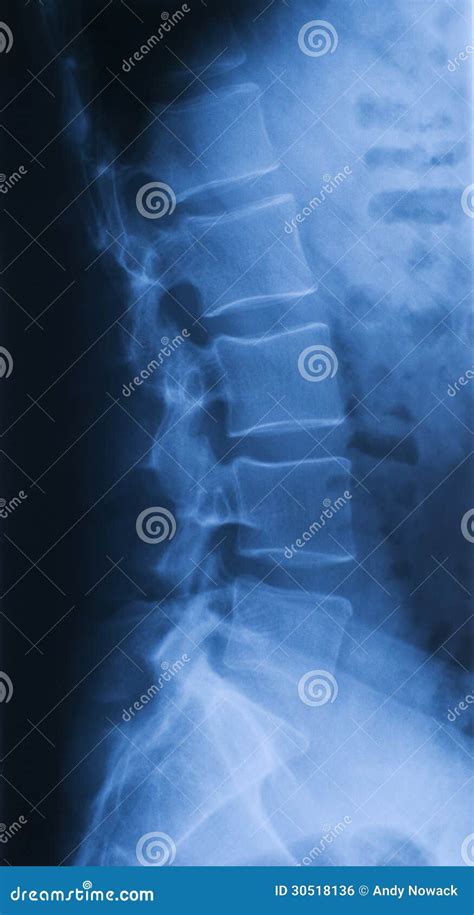 X Ray Of Pars Lumbalis Lateral Royalty Free Stock Image Image 30518136