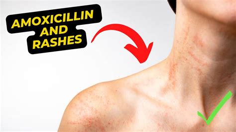 Amoxicillin And Rashes Understanding The Connection And How To Manage
