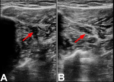 Ultrasound Of The Right Lower Extremity Within The Anterior Peroneal