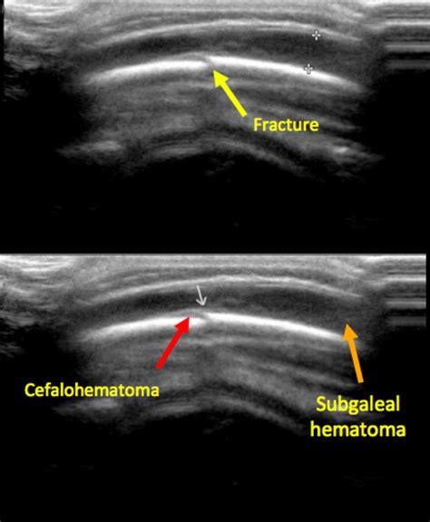 Subgaleal Hematoma Ultrasound