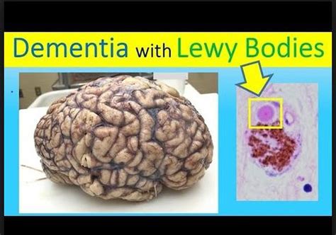Dementia With Lewy Bodies Symptoms And Causes