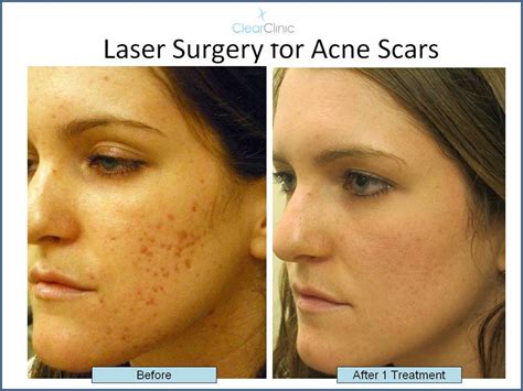 Treating Post Pimple Redness Laser Treatments For Red Spots From Acne