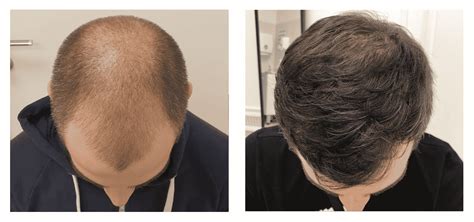 Fue Follicular Unit Excision Hair Transplant