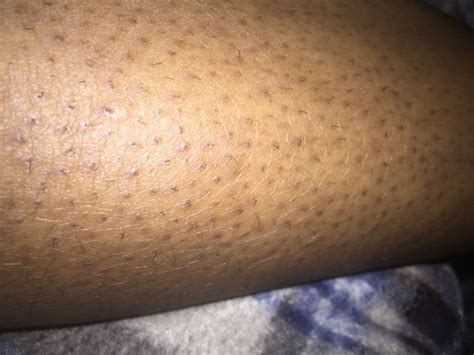 Sale Black Spots On Legs After Shaving In Stock