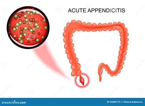 Acute Appendicitis Illustration And Light Micrograph Cartoondealer