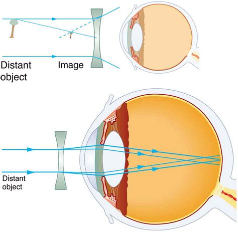 52 Vision Correction Douglas College Physics 1207