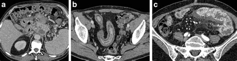 Abdominal And Pelvic Ct Is Positive Enteric Contrast Still Necessary