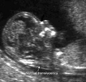 Women who cannot recall the dating scan with an ultrasound performed from the huggies pregnancy ultrasound screening test. Consider The Nuchal Translucency Scan Carefully ...