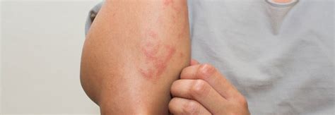 5 Ways To Lessen Itch From Poison Oak And Poison Ivy North Pacific