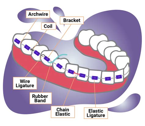 4 Types Of Braces Procedures Costs And Faqs 2022