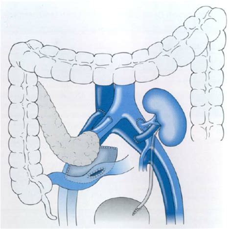 The Enteric Drainage Technique In Simultaneous Pancreas And Kidney