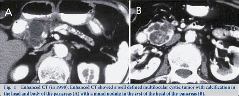 Figure 1 From A Resected Case Of Invasive Carcinoma Derived From