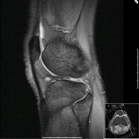 T2 Weighted Mri Image Demonstrating Lateral Meniscal Tear Absent Bow