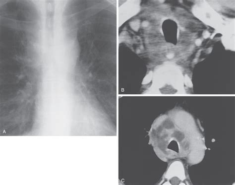 Mediastinitis Radiology Key