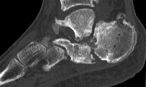 Symptomatic Nonunion After Fracture Of The Calcaneum Bone And Joint