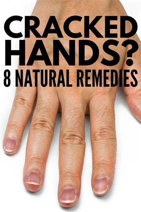 Severely Cracked Hands 8 Tips And Remedies For Fast Relief Dry Cracked