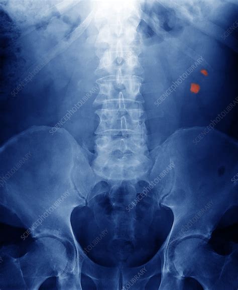 Kidney Stones X Ray Stock Image M1950153 Science Photo Library