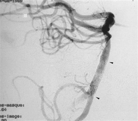 Primary Basilar Artery Stenting Immediate And Long Term Results In One