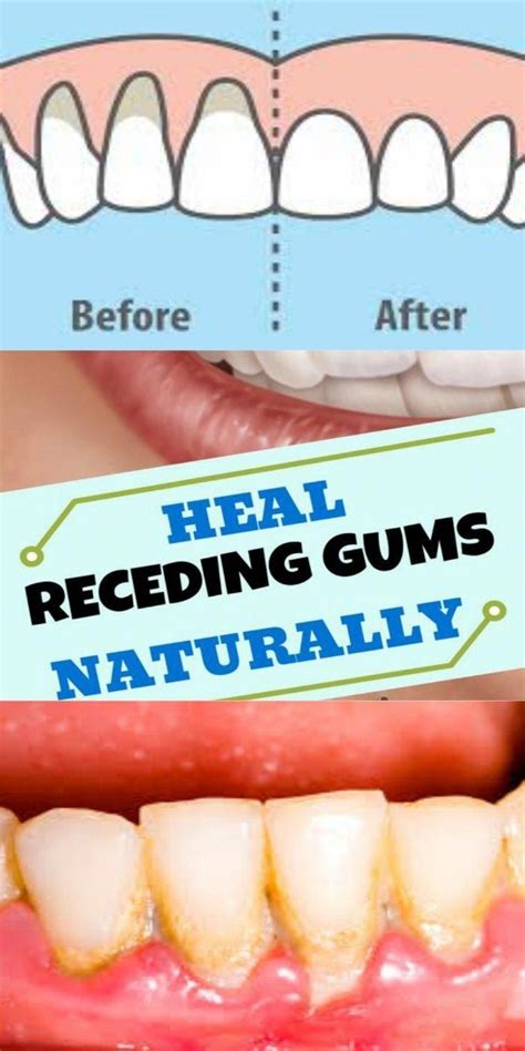 10 Easy Ways To Heal Receding Gums Naturally Fitness Care Plan In
