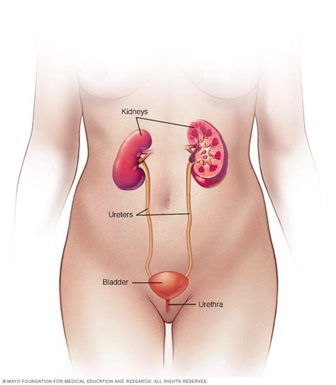 A cancerous or malignant tumor can spread (metastasize) to other tissues and vital organs. Kidney infection - Symptoms and causes - Mayo Clinic