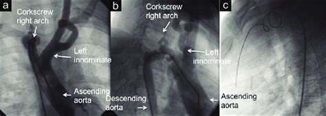 Aortic Arch Angiogram Of The Second Patient In Anteroposterior A And