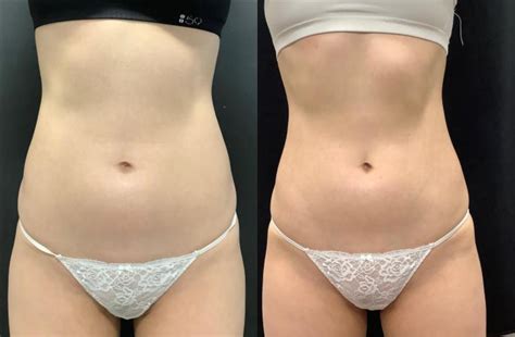 Accufit Before And After Photo Gallery Washington Dc Mi Skin Dermatology Center Melda Isaac Md