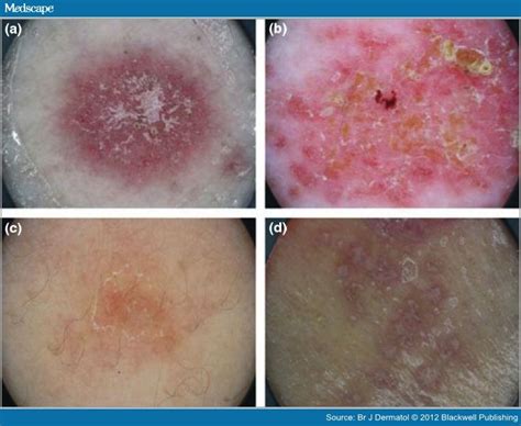 Dermoscopy For Diagnosis Of Inflammatory Skin Diseases