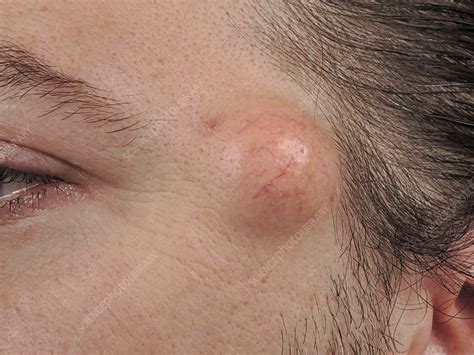 Sebaceous Cysts On Back Of Neck Sebaceous Cyst Causes