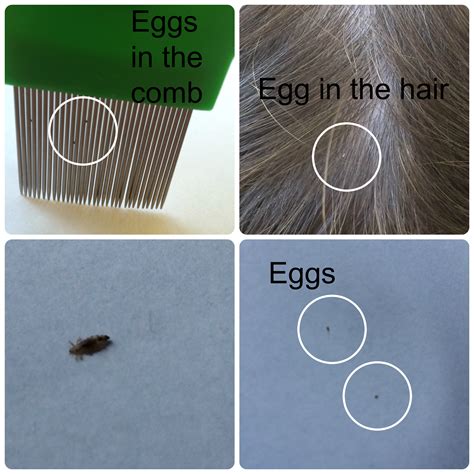 How To Start A Lice Removal Business Signoreroegner 99