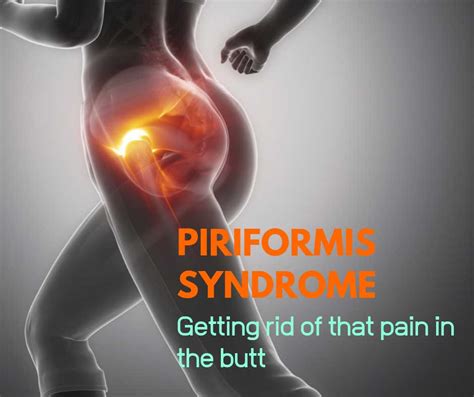 Buttock Pain Piriformis Syndrome
