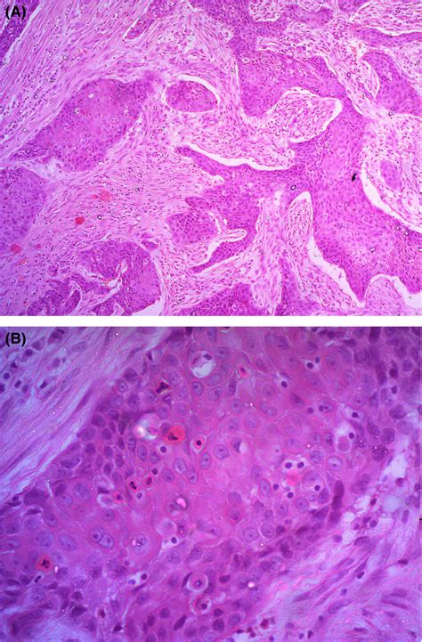 Aggressive Squamous Cell Carcinoma Of The Bladder Associated With A